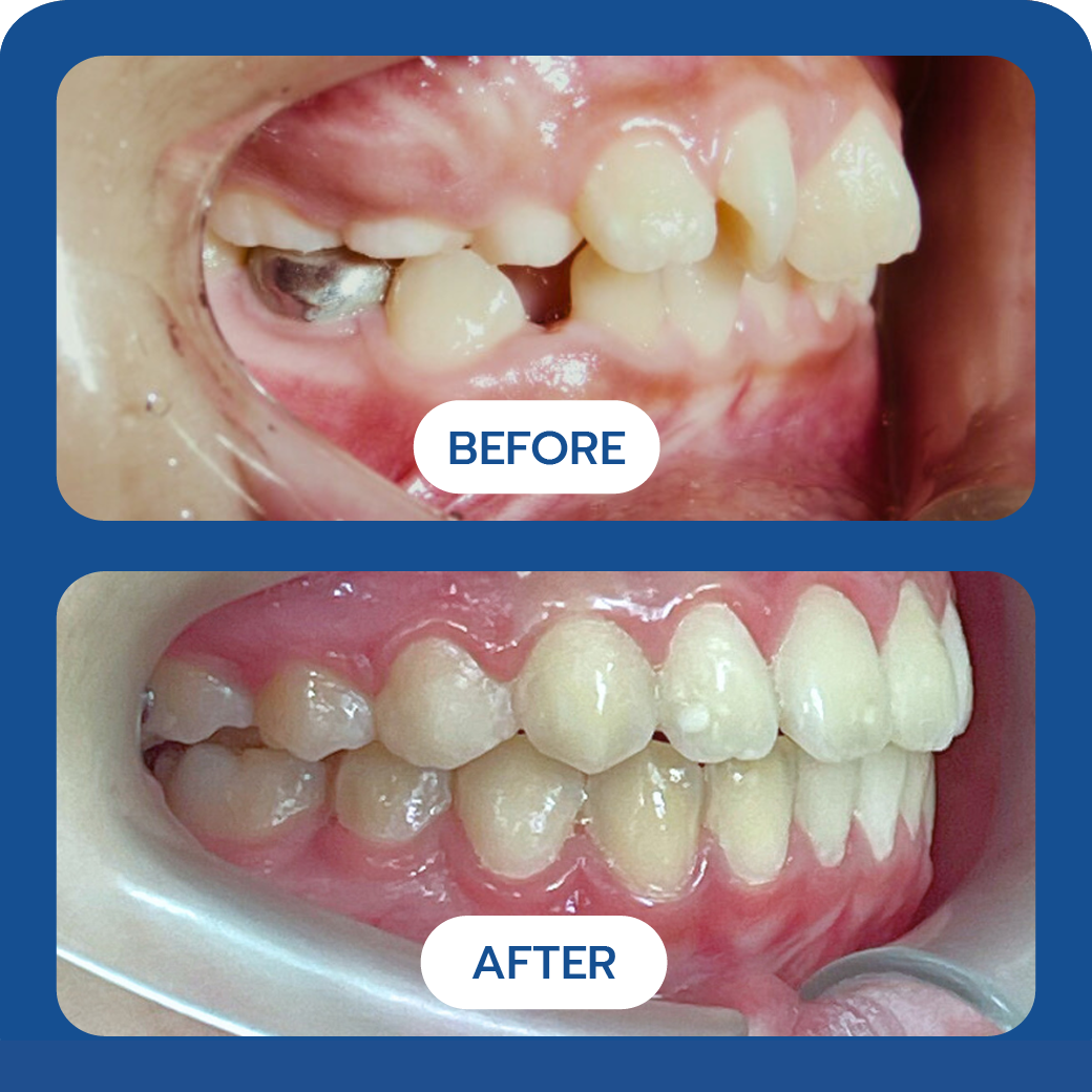 Invisalign Before and After Case 1